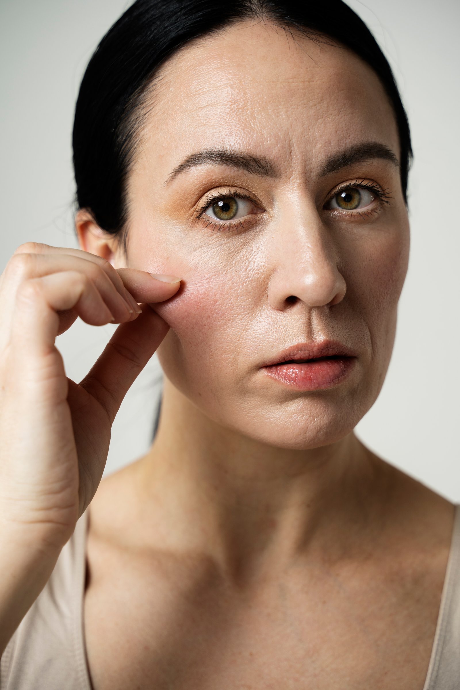Melasma Treatment