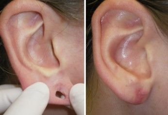 Split Earlobe Repair