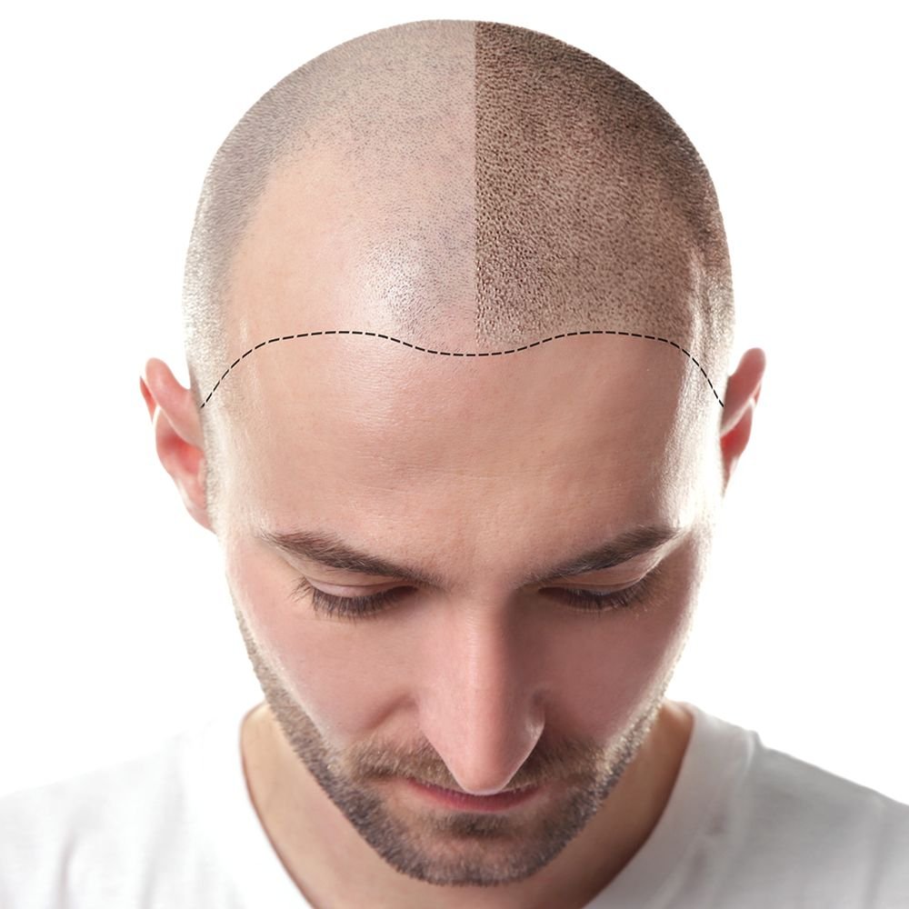 Scalp Micropigmentation (SMP) in Bhilai